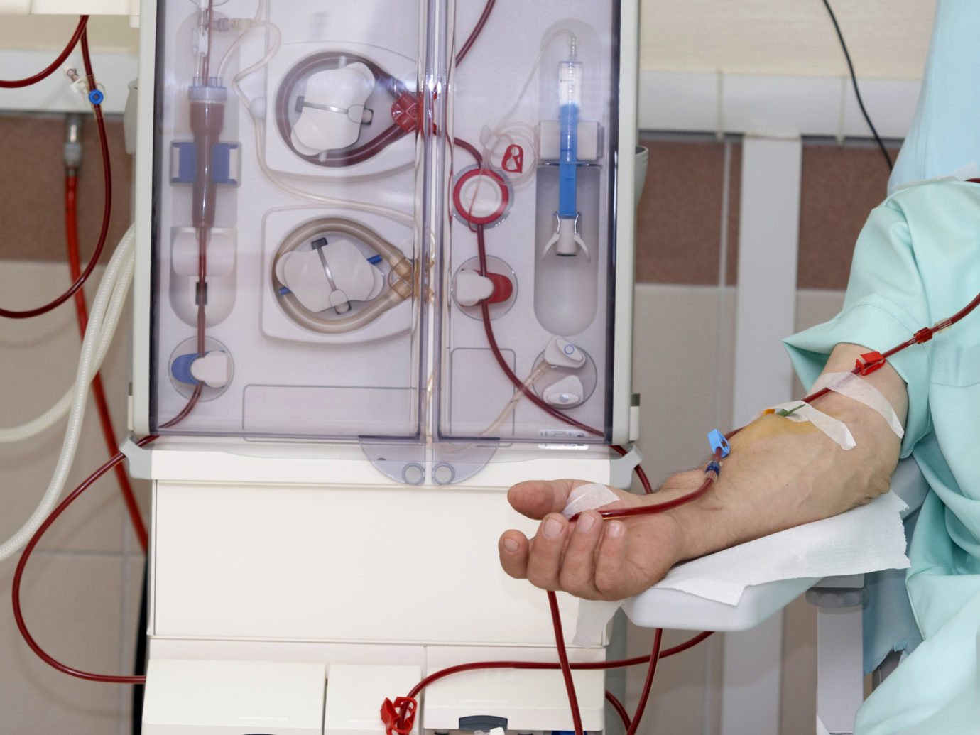 Hemodialysis machine with a patient